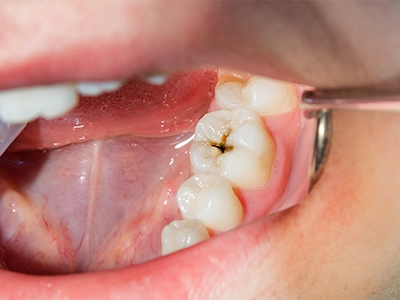 むし歯治療のイメージ画像