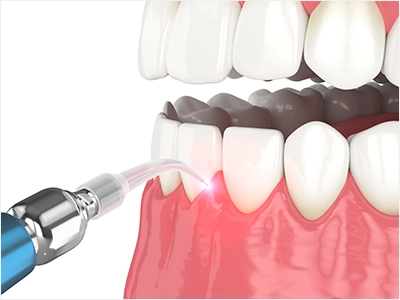 歯周病治療のイメージ画像