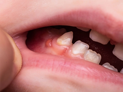口内炎・口腔内のできもののイメージ画像